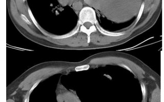 CT减影技术，ct减影处理方法